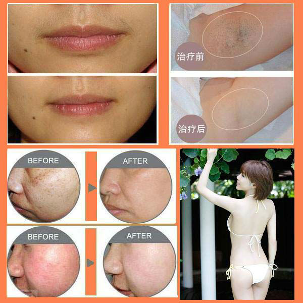 Venta caliente en removel del pelo del salón de belleza IPL